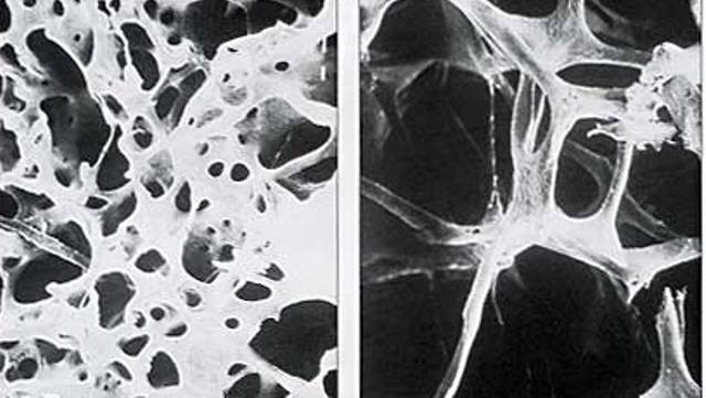 Гистоморфологические изменения костей при остеопорозе