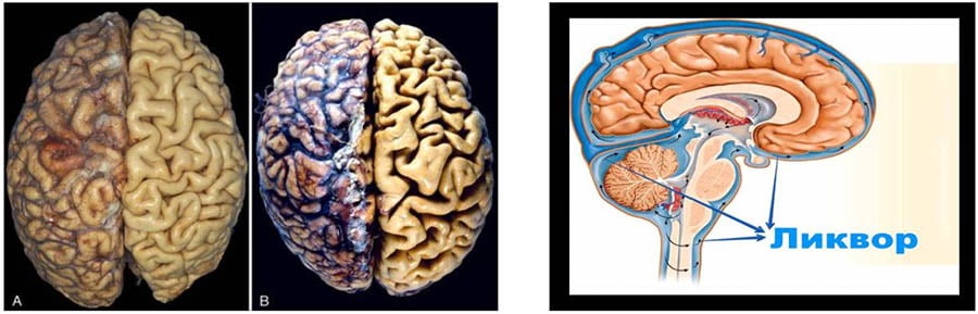 Ликворные пространства головного. Наружные ликворные пространства головного мозга. Ликвор в головном мозге. Расширение ликворных пространств головного мозга. Расширение наружных ликворных пространств.